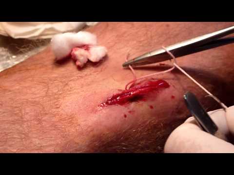 comment soigner point de suture