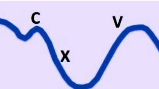 Jugular venous pressure-waveform