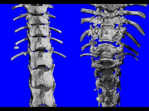 Image - HSS Minute: Unique Vertebral Stem Cells Carries Potential to Revolutionize Patient Care