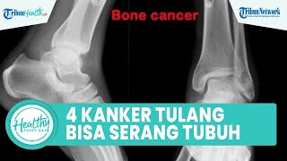 4 Jenis Kanker Tulang yang Dapat Menyerang Tubuh, Satu di Antaranya Osteosarcoma