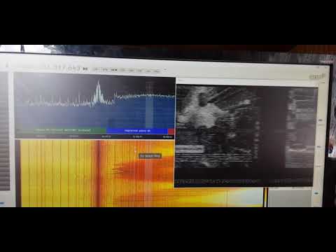 DX - Analog TV - 1TV Kinsty, Russia 1400Km