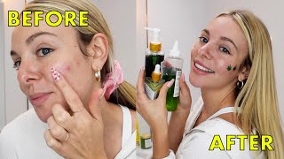 How I Get Rid of My Acne Overnight | Must Have Skincare Products for Acne-Prone Skin