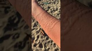 Quick Tips to Survive a Jellyfish Sting #shorts