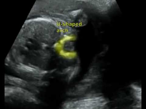 Fetal Medicine Foundation - Thoracic spina bifida