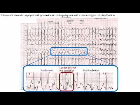 ECG in 60s - Wolff-Parkinson White