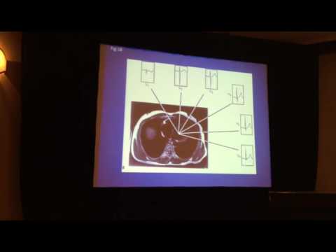 Galen S. Wagner MD, "3D ECG images of Ischemia and Infarction", at ISCE 2014