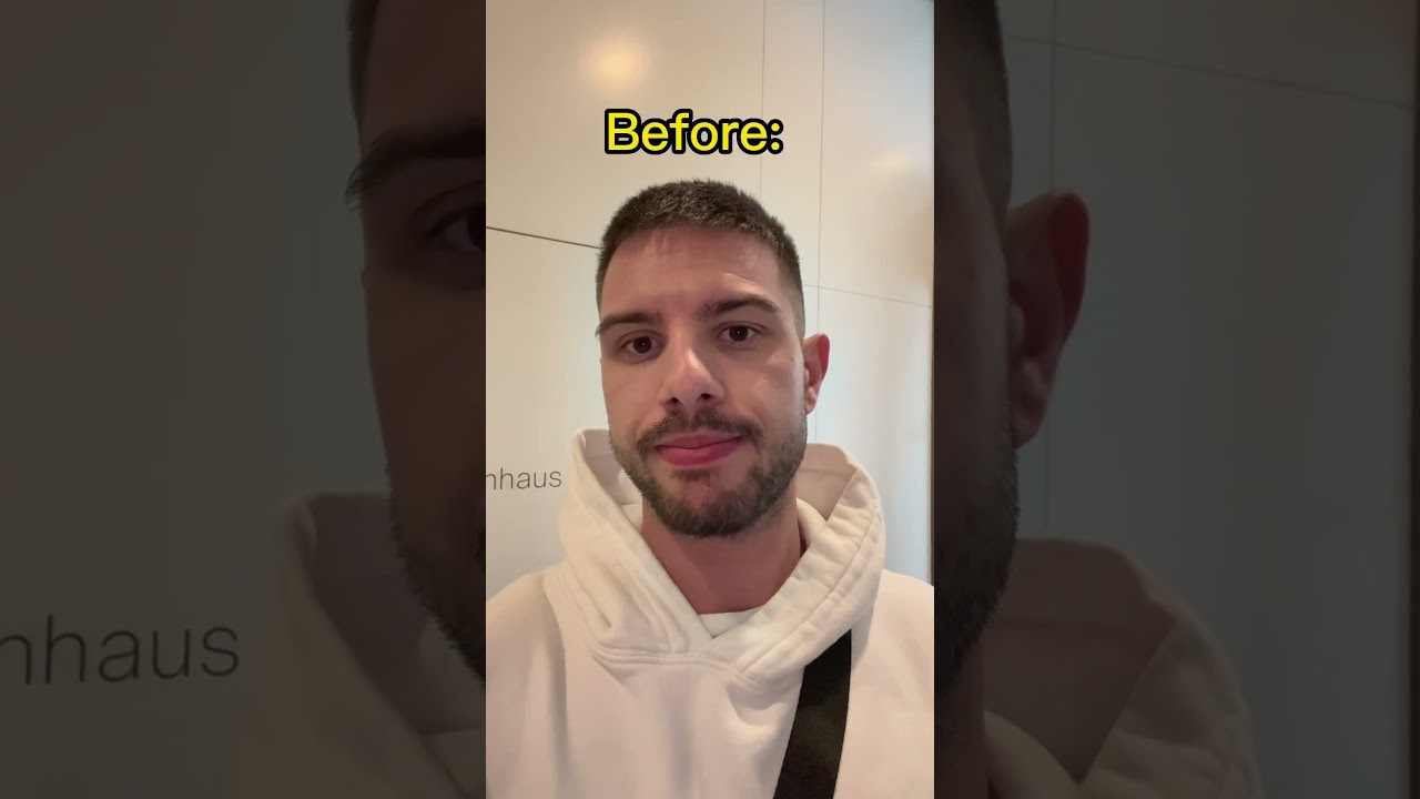 🍍🍍🍍 pineapplejuice before whisdom teeth surgery! #teeth  #whisdomteeth #surgery #pineapple #fit