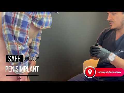 Penile Implant Video (inflate/deflate) Dr Tas, Istanbul  Turkey