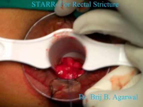 Staplerowa trans analna resekcja odbytnicy z powodu zwężenia po leczeniu hemoroidów metodą staplerową.