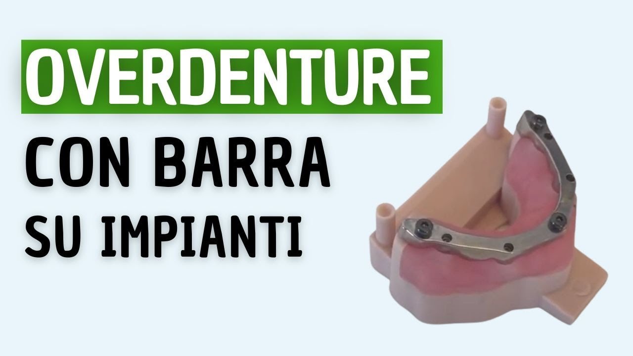 Watch Now BARRA su Impianti dentali per OVERDENTURE BARRA su Impianti dentali per OVERDENTURE