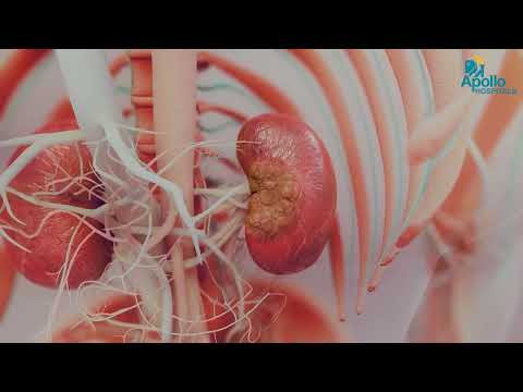 Antenatal to Postnatal Hydronephrosis Care | Dr. Balamourougane P | Apollo Hospitals