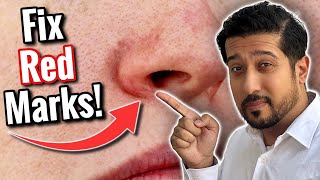 Face is Red, What to Do? | Get Rid of Perioral Dermatitis FAST