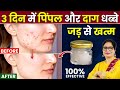 सिर्फ 2 चीज से पिंपल मुंहासे दाग धब्बो�