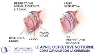 Le apnee ostruttive notturne: come risolverle con la chirurgia