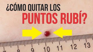 PUNTOS RUBÍ (NEVUS RUBÍ) 🔴 ¿Cómo ELIMINAR RÁPIDAMENTE 💋 Eterna Juventud Medical Estetic Center