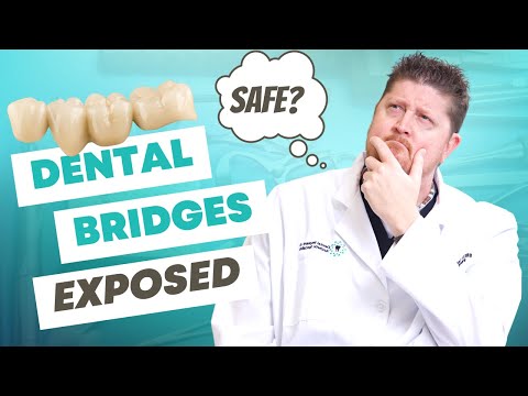 5 Things You Didn't Know About Dental Bridges (but should!)