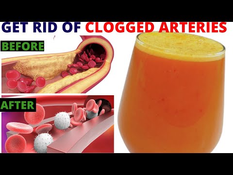 Strong Drink To Unclog Arteries & Heart: 1 Glass In The Morning Will Be Amazing - (Plaque Removal)
