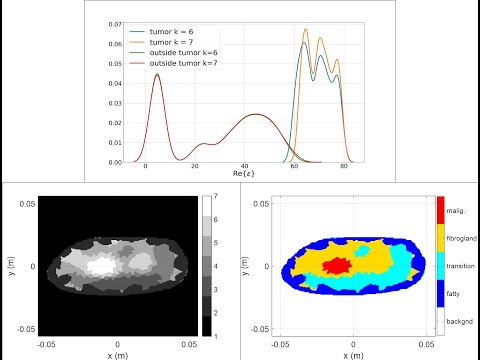 Extremely Dense breast detailed demonstration of iterative unsupervised machine learning segmentation technique