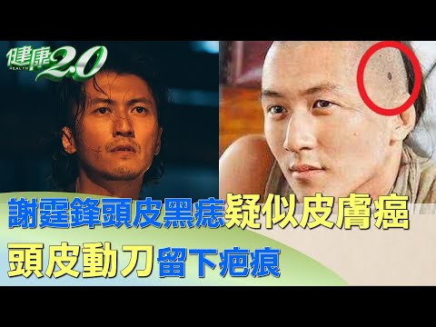 頭長痣