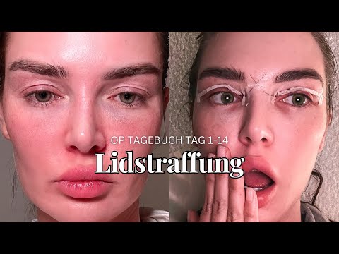 Eyelid lift healing process surgery diary day 1-14 BEFORE - AFTER