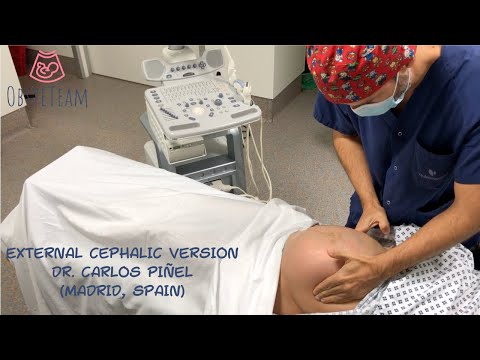 EXTERNAL CEPHALIC VERSION for BREECH BABY. An option for achieving a safe vaginal delivery.