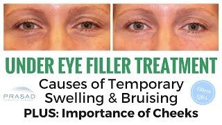 Treating Hollow Under Eyes: Temporary Swelling and Bruising, and Importance of Cheek Volume