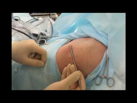 Артроскопия плечевого сустава и субакромиального пространства. Доступы и обзор
