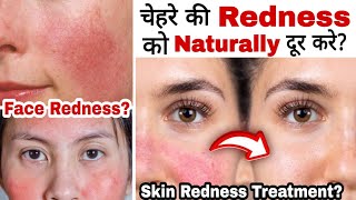 किसी Cream के Side effect या face Redness को कैसे ठीक करें? | Treatment For Face Redness at Home?