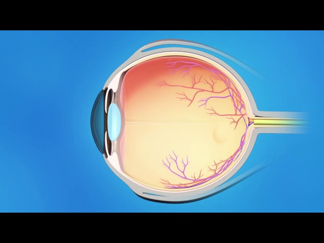 Glaucoma Laser Trabeculoplasty