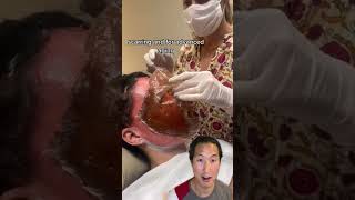 Watch Her Skin Get Lifted Off Her Face! #phenol #chemicalpeel