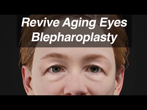 Blepharoplasty (Eyelid Surgery) to Revive Aging Eyes and Look Years Younger