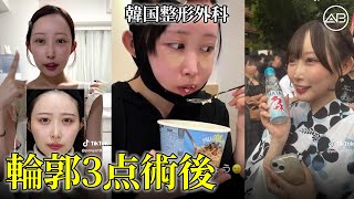 韓国美容整形で輪郭手術を受けてみた | AB美容整形