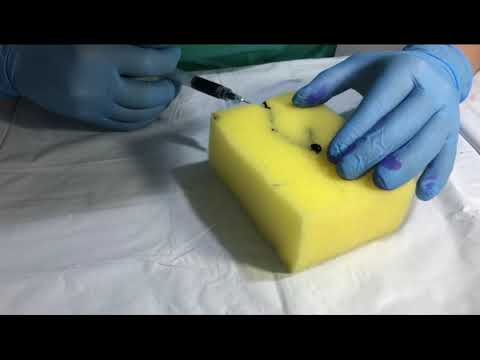 Anestésico Local - Método del Rombo