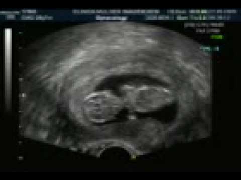 Emilianna e wagner o nosso primeiro baby ultrasson