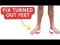 Fix TURNED OUT Feet With Two Easy Exercises Duck Feet