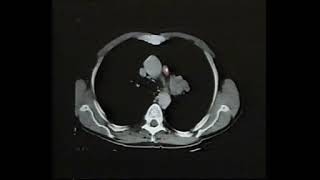 lung cancer I