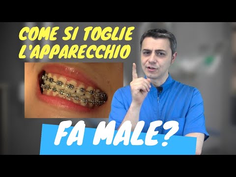 download lagu mp3 mp4 Mettere L Apparecchio Fisso Fa Male, download lagu Mettere L Apparecchio Fisso Fa Male gratis, unduh video klip Mettere L Apparecchio Fisso Fa Male