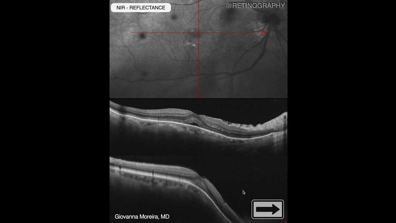 DOME-SHAPED MACULA MULTIMODAL IMAGING ANALYSIS