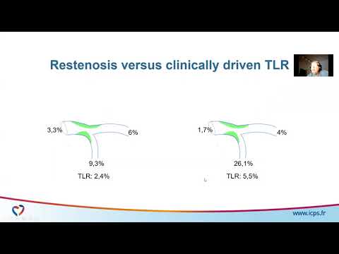 All bifurcations fulfilling the Definition 2 criteria should be stented with DK crush technique..CON
