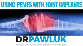 FAQ - Can Magnetic Field Therapy be used if you have joint implants?