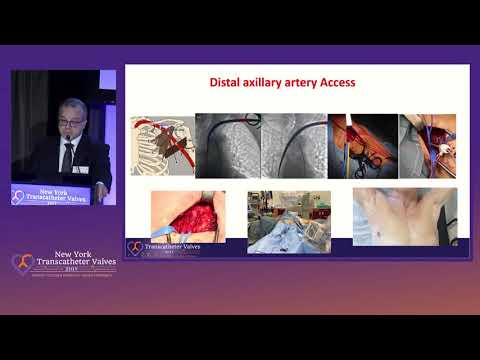Alternate Vascular Accesss of TAVR