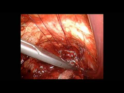 Radical Prostatectomy - Functional Urethral Sphincter Preservation