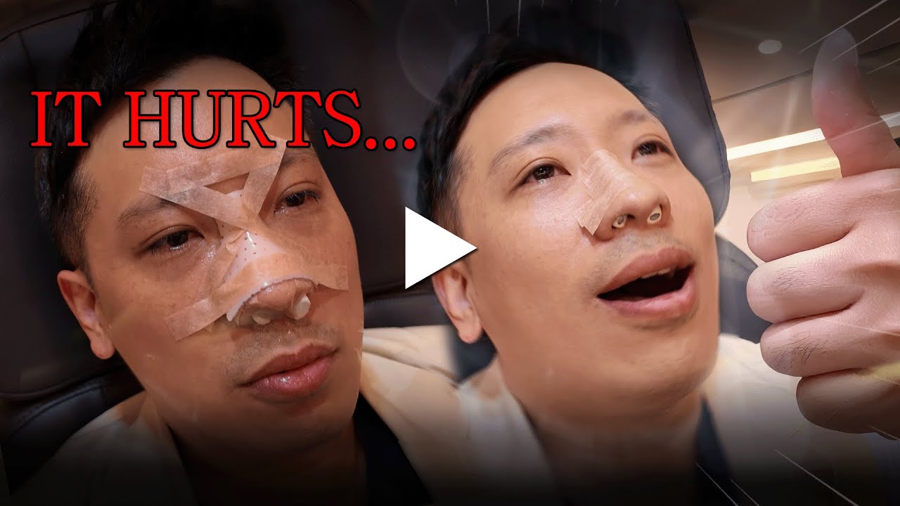 Rhinoplasty without surgery non-surgical nose procedure NANA Korea YouTube video