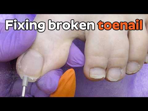 How to Fix a Broken Toenail – Gel Pedicure Tutorial on Webbed Toes *Satisfying*