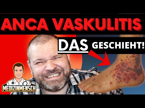 VASKULITIS! Rheuma-Arzt erklärt ANCA assoziierte Vaskulitis (Morbus Wegener Krankheit)