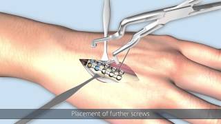 Linos | Transverse fracture of a metacarpal bone