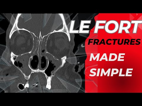 Le Fort fractures on CT