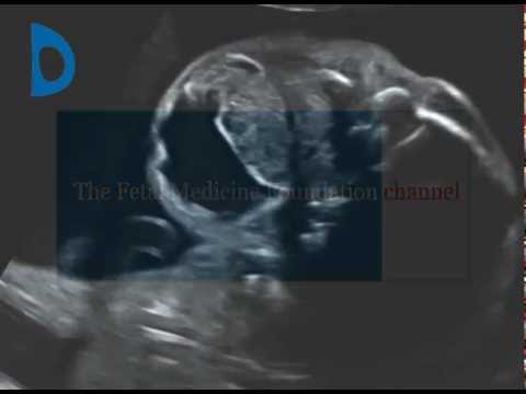 Fetal Medicine Foundation - neck teratoma