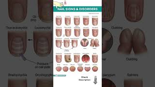 Your Nails Are Warning You! 24 Nail Signs That Reveal Hidden Diseases