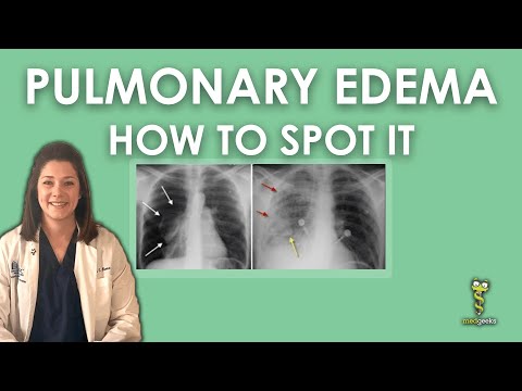Pulmonary Edema Chest X-ray